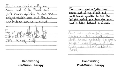 Handwriting Examples of Pre-Vision Therapy and Post-Vision Therapy